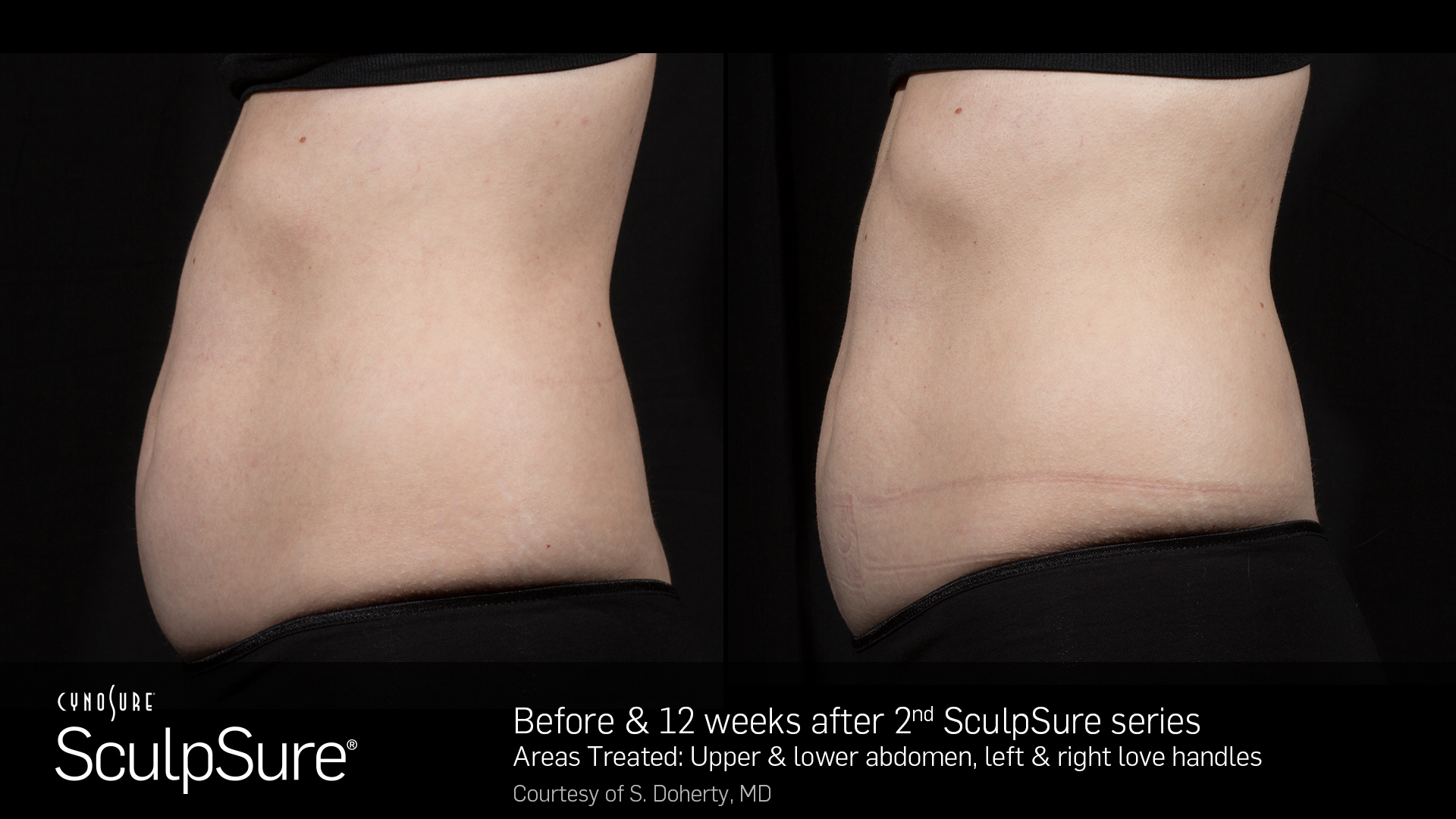 SculpSure Example - Abdomen & Love Handles