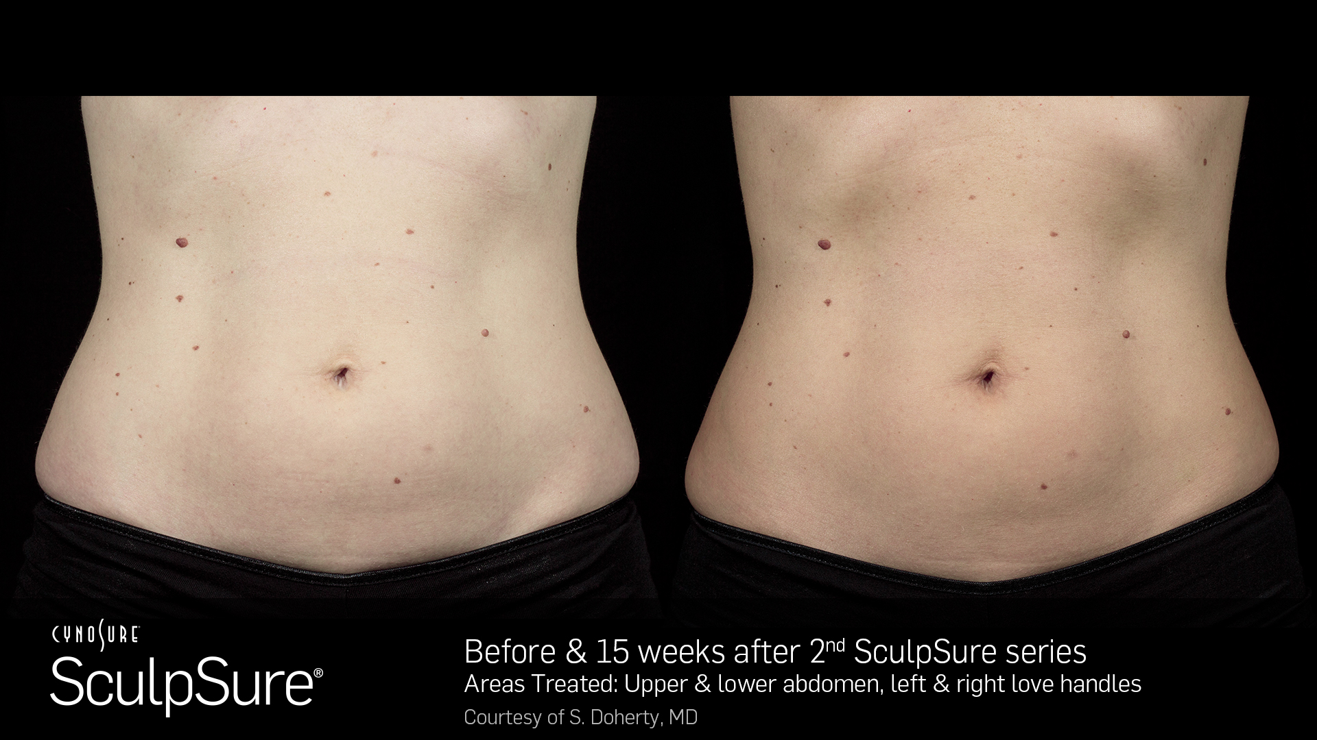 SculpSure Example - Abdomen & Love Handles